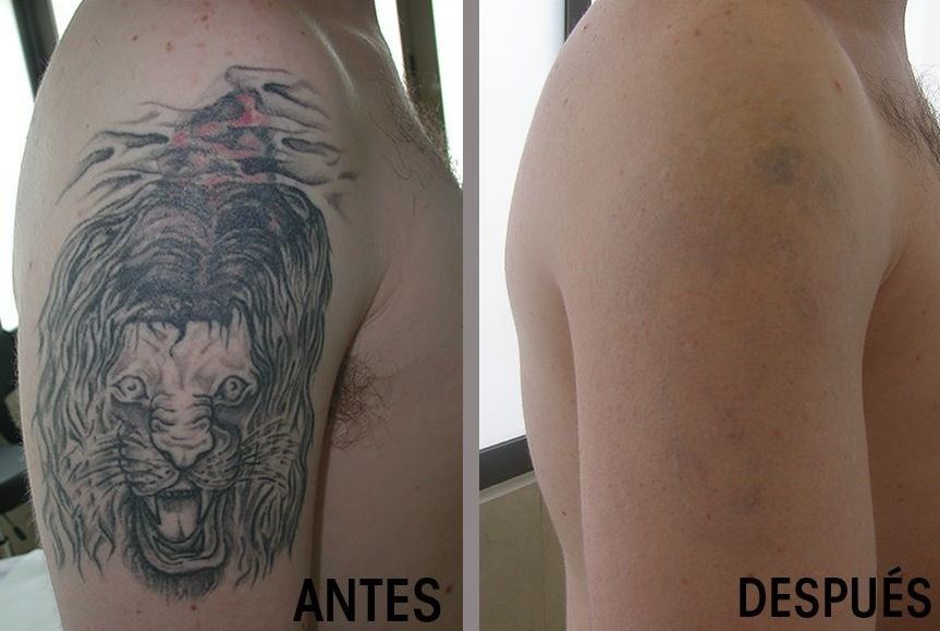 La eliminación de tatuajes con láser
