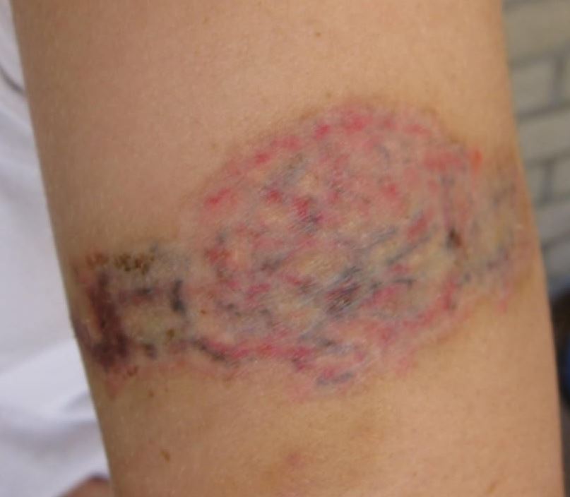 Eliminación de tatuajes salabrasión