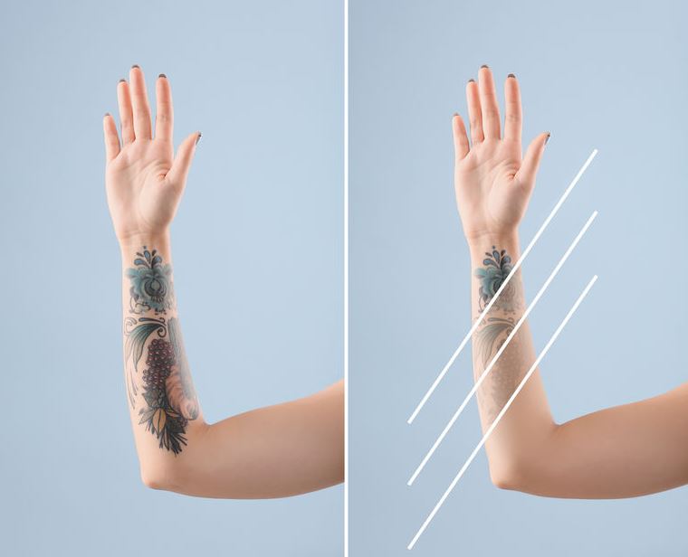 cirugia para quitar tatuajes