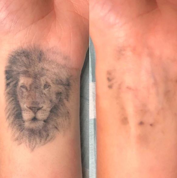 cirugia para quitar tatuajes
